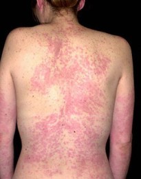 hives